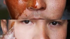 Doğum Lekesi Nasıl Geçer