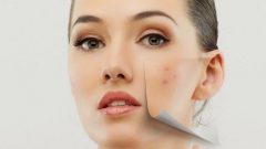 Yüz ve Sırttaki Sivilceleri Giderme Yöntemleri