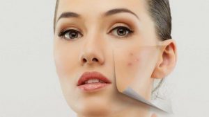 Yüz ve Sırttaki Sivilceleri Giderme Yöntemleri