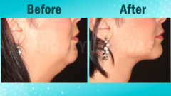 Gıdı Liposuction: Gıdı Eritmenin Ömürlük Sonucu