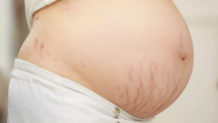 Hamilelik Çatlağı Azaltma Yolları Nedir?