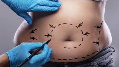 Liposuction Nedir?