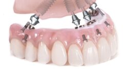 Dental Implant Tedavisi Hakkında Bilgi