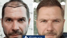 Saç Ekim Sonrası Süreçte Neler Yaşanır?